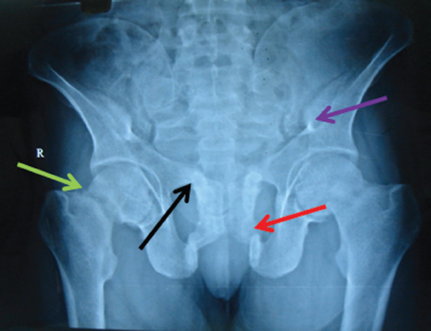 Fracture of the bilateral iliac bone (purple arrow) and old healed fractures of neck of the femur (green arrow), superior (black arrow) and inferior (orange arrow) pubic rami.